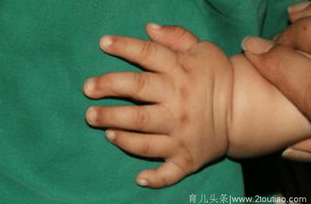 孩子出生就有25根指头，医生看到宝妈的手，明白了原因