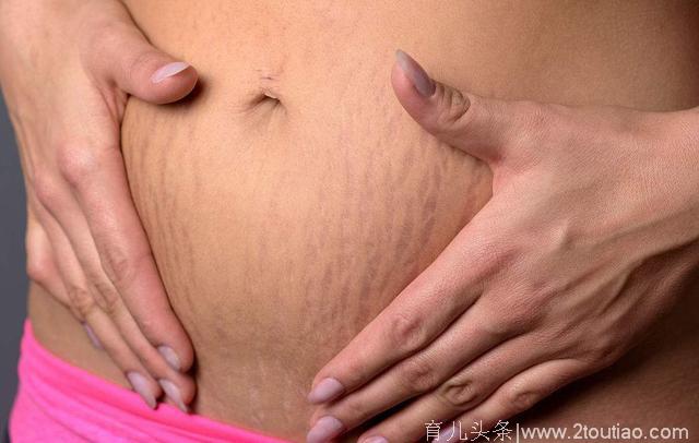 怀孕6个月长妊娠纹，和妊娠纹的大战要打响了……
