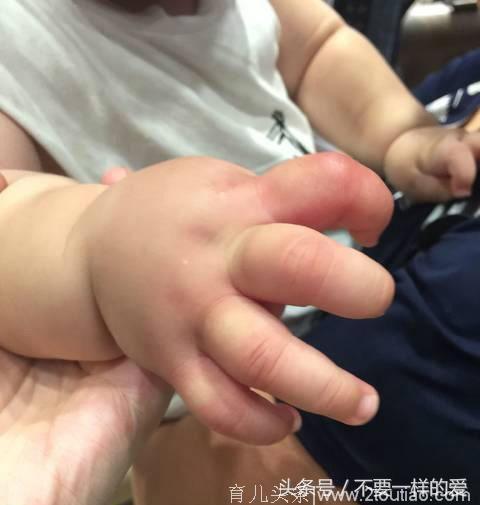 八个月孩子手指突然肿胀，医生检查结果出来后，父亲狂扇自己耳光