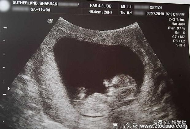 女子流产后把14周大10厘米长的死胎埋花园，分享照片劝不要堕胎