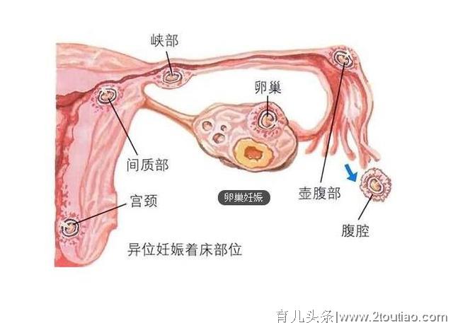 经历过宫外孕的您知道自己是四种类型宫外孕中的哪一种么？