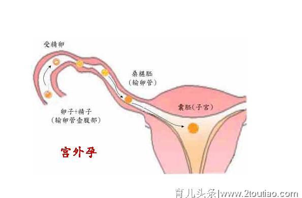 34岁女子两次宫外孕后，一侧输卵管被切除，如何实现“求子梦”？