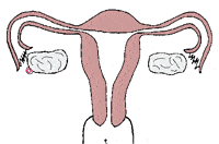 一侧输卵管宫外孕保守治疗后多久可以备孕？