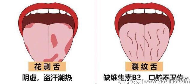 孩子舌头有这些变化，说明脾胃不健康了，这样调理孩子少受罪