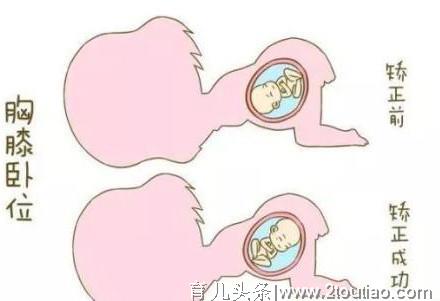 胎儿臀位能顺产吗?孕妈必知：纠正胎儿臀位的最佳时间和方法！