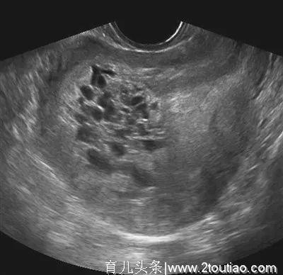 孕妇3个月时肚子大如临盆，产检却听不到胎心，孩子最终不能要