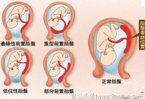 二胎患凶险性胎盘前置，危及母婴生命！孕期5大动作孕妈需警惕！
