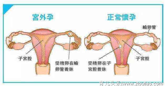 大学生性知识薄弱，造成宫外孕！！！