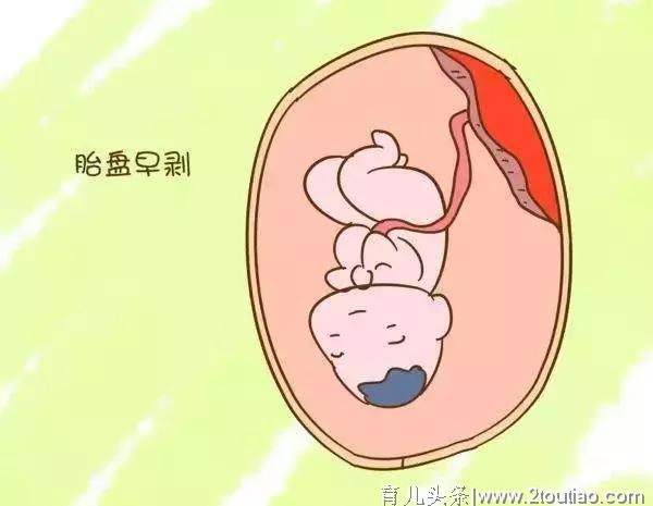 急！株洲孕妈怀孕31周，1/2的胎盘与子宫剥离！