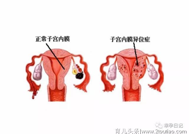 如果你在备孕路上遇到了子宫内膜异位症，该怎么办