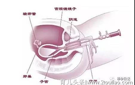 如果你在备孕路上遇到了子宫内膜异位症，该怎么办