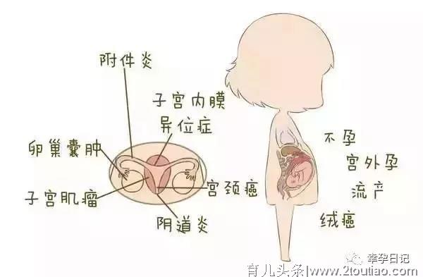 如果你在备孕路上遇到了子宫内膜异位症，该怎么办