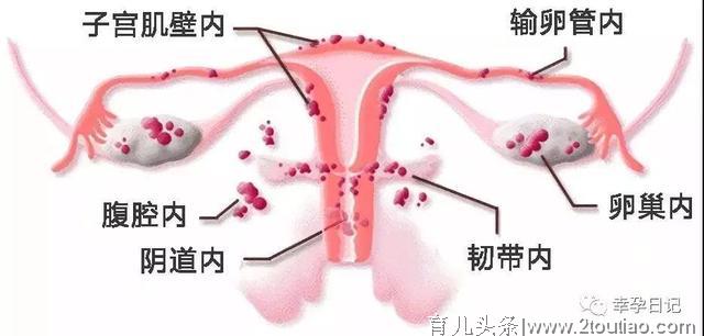 如果你在备孕路上遇到了子宫内膜异位症，该怎么办