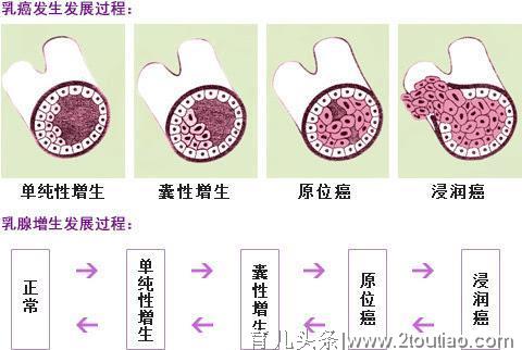 厘清乳腺增生跟乳腺癌的前世今生！妈妈要知道调理的10个误区