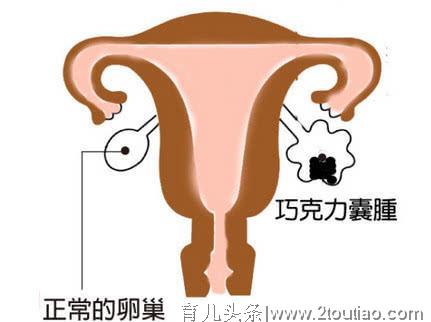 她25岁切除3/4的子宫，用1/4的子宫顺产一女婴，创造奇迹