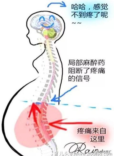 无痛分娩时代到来！你还在担心分娩镇痛的安全性吗?