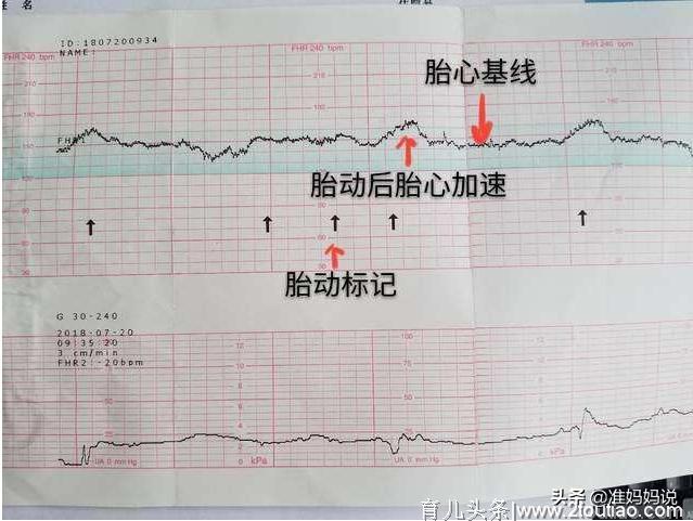 纪实：一波N折的剖腹产经历，胎监过不了没想到这么惊险