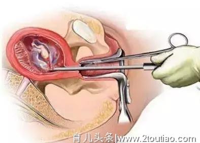 医生，您觉得哪个好？ ——论药物流产与人工流产孰优孰劣