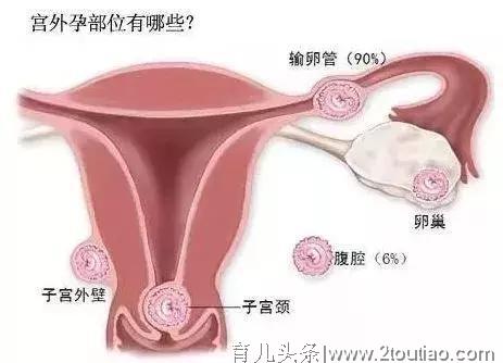 宫外孕误当胃肠炎，株洲女子腹腔出血3500ml险丧命！