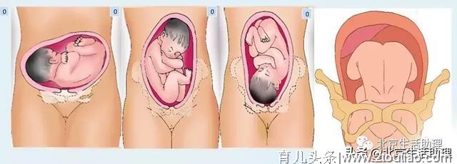 顺产？剖宫产？决定分娩的因素有哪些？