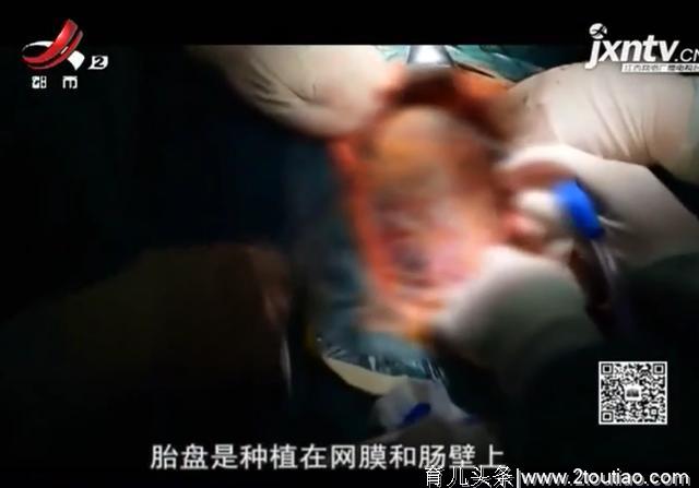 幸运！宫外孕孕妇腹腔妊娠 又不定期体检  医生：胎儿存活率仅为百分之一