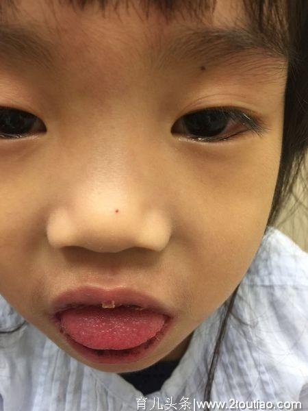 小宝患非典型川崎病，新加坡住院4天之记录