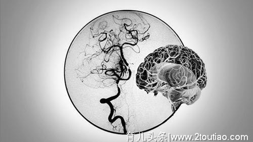 这种脑血管病，好发于儿童和青壮年，医生：出现3症状，及时就医