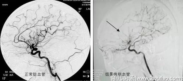 这种脑血管病，好发于儿童和青壮年，医生：出现3症状，及时就医