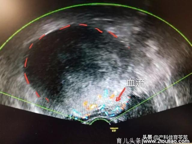 以为得了肿瘤了，居然是宫外孕