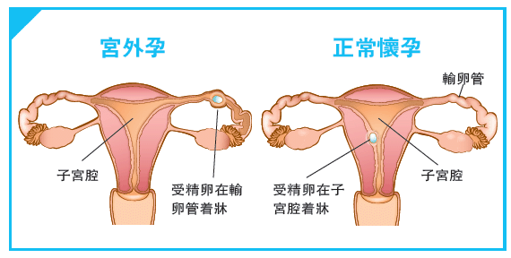 宫外孕还可以再怀孕吗？导致宫外孕的5大原因，不得不防