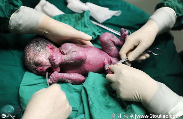 剖腹产手术，为何取出胎儿必须在15分钟内？决定剖腹产的孕妈了解