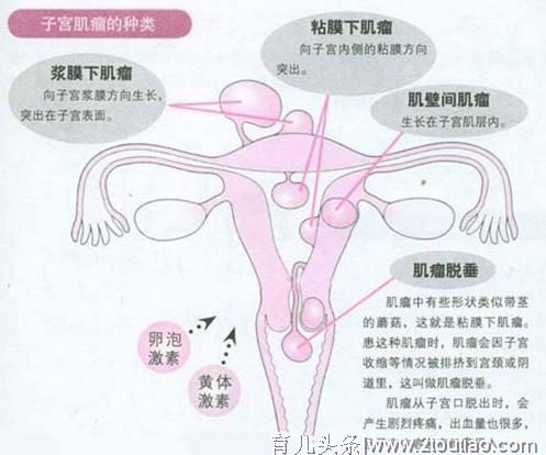 数据显示：每5个女性中就有一位患子宫肌瘤，如何自我检测