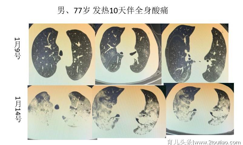 武汉的新型病毒肺炎疫情在变严重吗？你想知道的都在这里