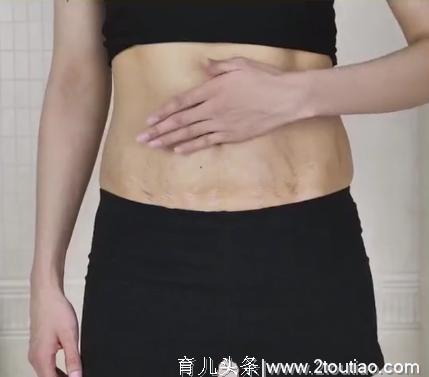 如何去掉妊娠纹，宝妈产后恢复窍门，让妊娠纹彻底消失