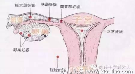 这3种女性极易宫外孕，有这4种情况可能是宫外孕，需尽快就医！