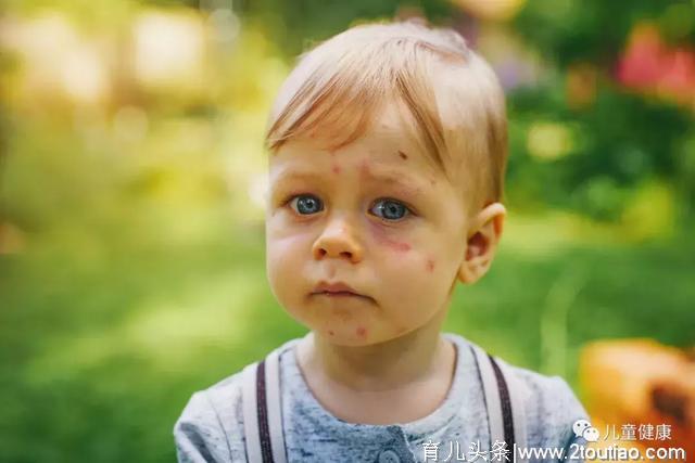 春季幼儿高发传染病预防小常识！