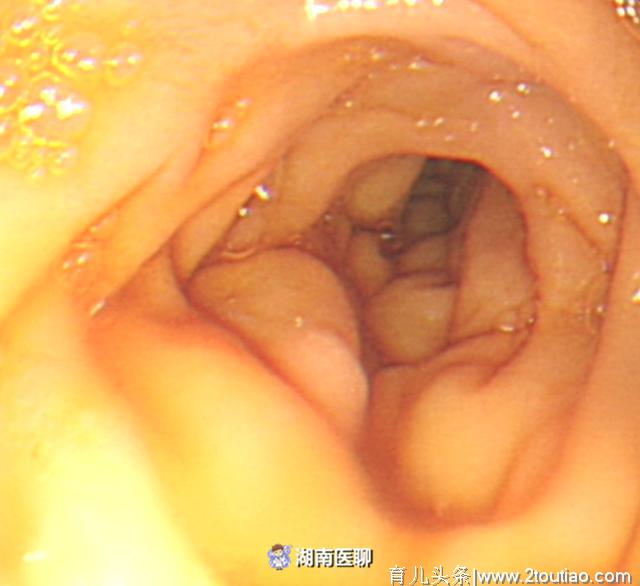 刚剖腹产出院，女子大口呕血！这种隐性遗传病险些要了她命