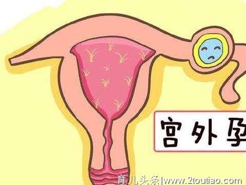 为什么感觉宫外孕那么常见，切了输卵管女性怎么办？