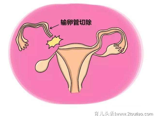 为什么感觉宫外孕那么常见，切了输卵管女性怎么办？