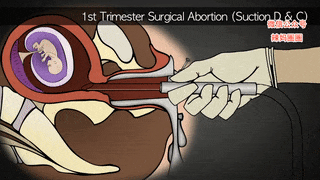 哪一种的流产方式危害最大，进来看看吧