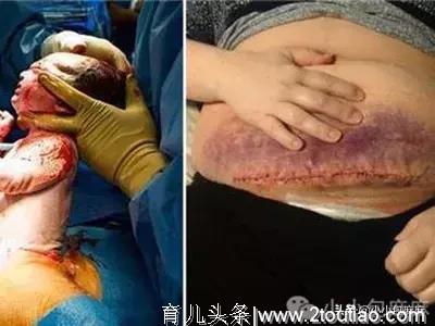 3分钟剖腹产视频曝光，哪个女人不是在用命生孩子…