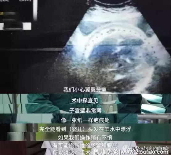 3分钟剖腹产视频曝光，哪个女人不是在用命生孩子…