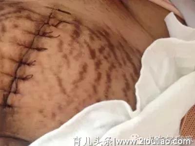 3分钟剖腹产视频曝光，哪个女人不是在用命生孩子…