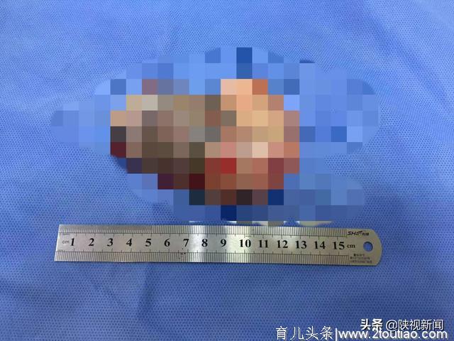 百天婴儿接受特殊“剖腹产”手术   取出一“寄生胎”