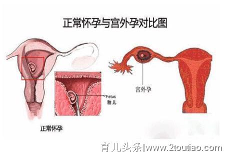 妇科医生：8大因素需警惕，帮您远离宫外孕！