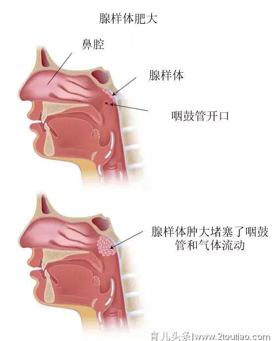 因这个小毛病，孩子智商停留在2岁！4岁前不治好，孩子长成矮笨丑