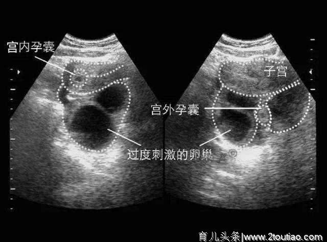 女性宫外孕，可能和老公的两个习惯有关，早知道早避免