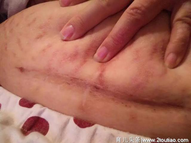 科普：顺产与剖腹产九个不同的护理方式，辛苦一个月却受益一辈子