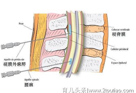 云南无痛分娩时代来临 生孩子是否彻底变成一件简单事