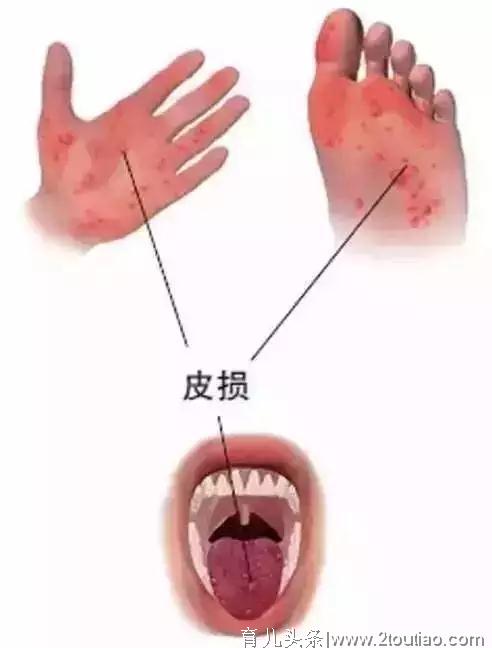 河南平均每年约10万儿童得这个病！又到高发期，家长要警惕！